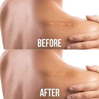 Cinta de Silicona Eliminación Cicatrices South Moon LB0889 Parches sin Dolor